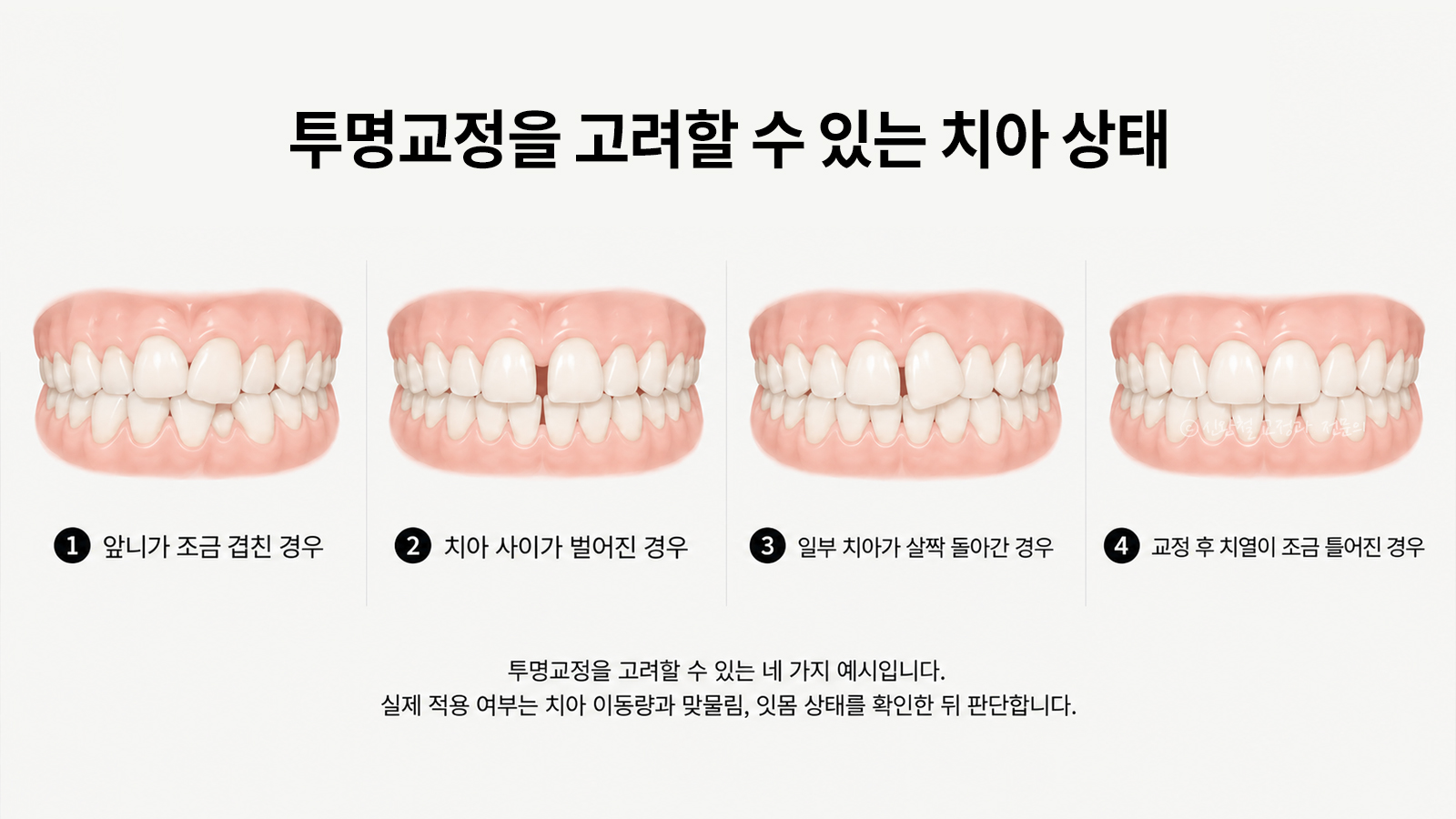 투명교정을 고려할 수 있는 치아 상태 네 가지 — 앞니가 조금 겹친 경우, 치아 사이가 벌어진 경우, 일부 치아가 살짝 돌아간 경우, 교정 후 치열이 조금 틀어진 경우