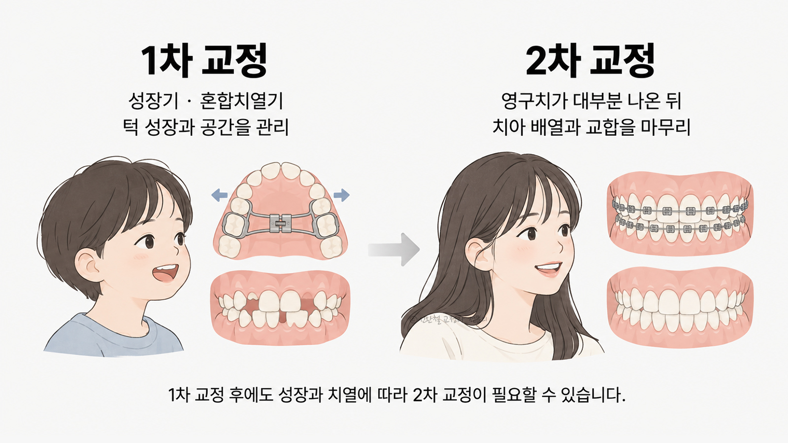 1차 교정(성장기 위턱 확장장치로 턱 성장과 공간 관리)과 2차 교정(영구치가 나온 뒤 브라켓으로 배열과 교합 마무리)을 나란히 비교한 그림