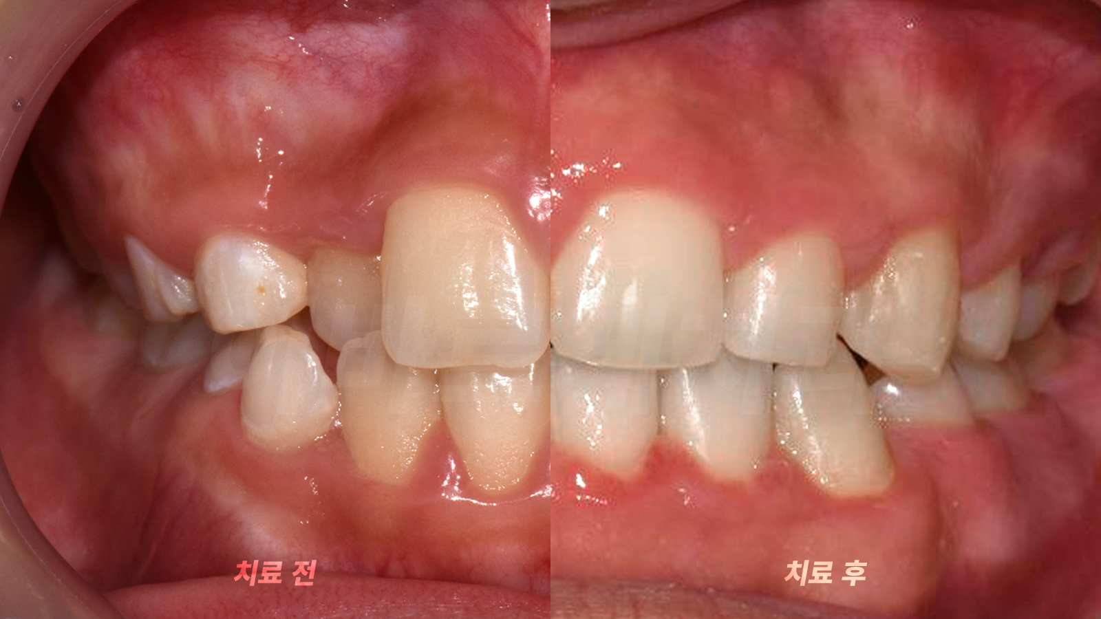 2차 교정 치료 전과 치료 후의 앞니 배열을 나란히 보여 주는 구강 내 사진